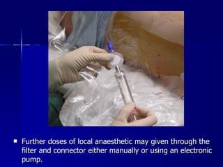 Further doses of local anaesthetic may given through the filter and connector either manually or using an electronic pump. 