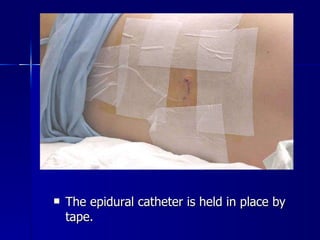 The epidural catheter is held in place by tape. 