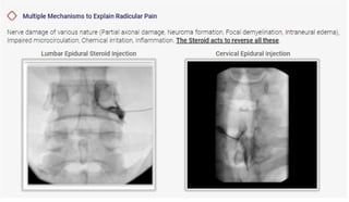 Joint Injection Bulging Disk Epidural steroid injections for disc prolapse | PPT