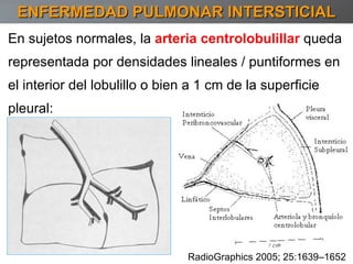 ENFERMEDAD PULMONAR INTERSTICIAL En sujetos normales, la  arteria centrolobulillar  queda representada por densidades lineales / puntiformes en el interior del lobulillo o bien a 1 cm de la superficie pleural: RadioGraphics 2005; 25:1639–1652 