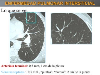ENFERMEDAD PULMONAR INTERSTICIAL Lo que se ve: Arteriola terminal : 0.5 mm, 1 cm de la pleura Vénulas septales  :  0.5 mm , “puntos”, “comas”, 2 cm de la pleura 