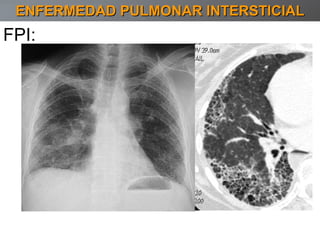 ENFERMEDAD PULMONAR INTERSTICIAL FPI: 