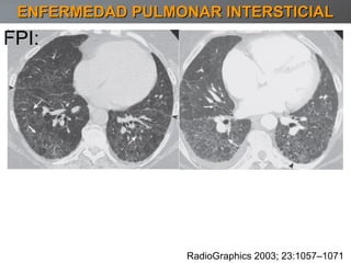 ENFERMEDAD PULMONAR INTERSTICIAL FPI: RadioGraphics 2003; 23:1057–1071 