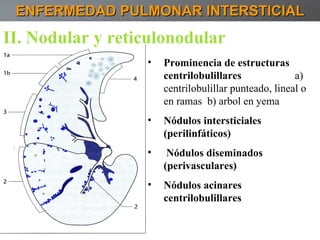 ENFERMEDAD PULMONAR INTERSTICIAL Prominencia de estructuras centrilobulillares  a) centrilobulillar punteado, lineal o en ramas  b) arbol en yema Nódulos intersticiales (perilinfáticos) Nódulos diseminados (perivasculares) Nódulos acinares centrilobulillares II. Nodular y reticulonodular 