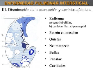 ENFERMEDAD PULMONAR INTERSTICIAL III. Disminución de la atenuación y cambios qúisticos Enfisema  a) centrilobulillar,  b) panlobulillar, c) paraseptal Patrón en mosaico Quistes Neumatocele Bullas Panalar Cavidades  