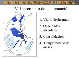 ENFERMEDAD PULMONAR INTERSTICIAL IV. Incremento de la atenuación Vidrio deslustrado Opacidades alveolares  Consolidación Conglomerado de masas 