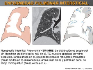 ENFERMEDAD PULMONAR INTERSTICIAL Nonspecific Interstitial Pneumonia NSIP/ NINE . La distribución es subpleural, sin identificar gradiente (área roja en a). TC muestra opacidad en vidrio despulido, (áreas grises en c), opacidades lineales reticulares irregulares (áreas azules en c), micronódulos (áreas rojas en c), y patrón en panal de abeja microquístico (áreas verdes en c). RadioGraphics 2007; 27:595–615 