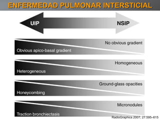 ENFERMEDAD PULMONAR INTERSTICIAL RadioGraphics 2007; 27:595–615 