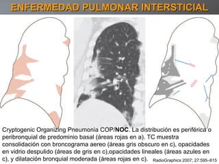 ENFERMEDAD PULMONAR INTERSTICIAL Cryptogenic Organizing Pneumonia COP/ NOC . La distribución es periférica o peribronquial de predominio basal (áreas rojas en a). TC muestra consolidación con broncograma aereo (áreas gris obscuro en c), opacidades en vidrio despulido (áreas de gris en c),opacidades lineales (áreas azules en c), y dilatación bronquial moderada (áreas rojas en c). RadioGraphics 2007; 27:595–615 