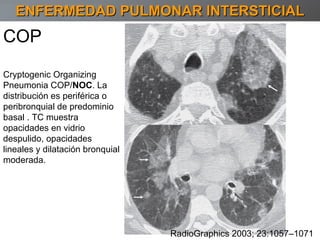 ENFERMEDAD PULMONAR INTERSTICIAL RadioGraphics 2003; 23:1057–1071 COP Cryptogenic Organizing Pneumonia COP/ NOC . La distribución es periférica o peribronquial de predominio basal . TC muestra  opacidades en vidrio despulido, opacidades lineales y dilatación bronquial moderada. 