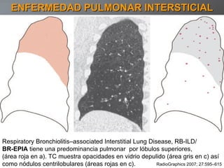 ENFERMEDAD PULMONAR INTERSTICIAL Respiratory Bronchiolitis–associated Interstitial Lung Disease, RB-ILD/ BR-EPIA  tiene una predominancia pulmonar  por lóbulos superiores, (área roja en a). TC muestra opacidades en vidrio depulido (área gris en c) así como nódulos centrilobulares (áreas rojas en c). RadioGraphics 2007; 27:595–615 