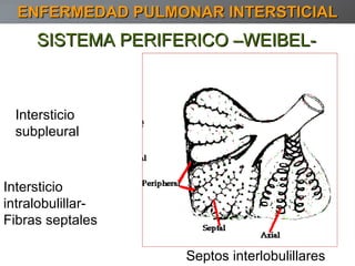 SISTEMA PERIFERICO –WEIBEL- Intersticio subpleural Septos interlobulillares Intersticio intralobulillar- Fibras septales ENFERMEDAD PULMONAR INTERSTICIAL 