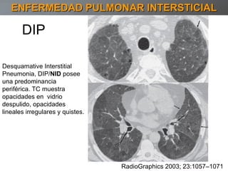 RadioGraphics 2003; 23:1057–1071 DIP ENFERMEDAD PULMONAR INTERSTICIAL Desquamative Interstitial Pneumonia, DIP/ NID  posee una predominancia periférica. TC muestra opacidades en  vidrio despulido, opacidades lineales irregulares y quistes. 