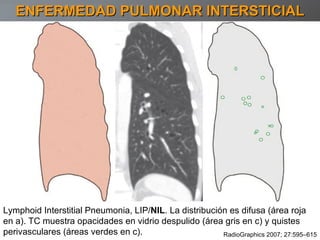 ENFERMEDAD PULMONAR INTERSTICIAL Lymphoid Interstitial Pneumonia, LIP/ NIL . La distribución es difusa (área roja en a). TC muestra opacidades en vidrio despulido (área gris en c) y quistes perivasculares (áreas verdes en c). RadioGraphics 2007; 27:595–615 