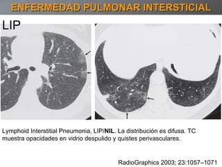 ENFERMEDAD PULMONAR INTERSTICIAL RadioGraphics 2003; 23:1057–1071 LIP Lymphoid Interstitial Pneumonia, LIP/ NIL . La distribución es difusa. TC muestra opacidades en vidrio despulido y quistes perivasculares. 
