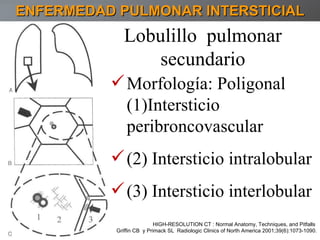 ENFERMEDAD PULMONAR INTERSTICIAL Lobulillo  pulmonar  secundario  HIGH-RESOLUTION CT : Normal Anatomy, Techniques, and Pitfalls  Griffin CB  y Primack SL  Radiologic Clinics of North America 2001;39(6):1073-1090. Morfología: Poligonal (1)Intersticio peribroncovascular (2) Intersticio intralobular (3) Intersticio interlobular 