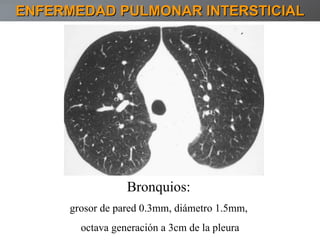 ENFERMEDAD PULMONAR INTERSTICIAL Bronquios:   grosor de pared 0.3mm, diámetro 1.5mm,  octava generación a 3cm de la pleura 