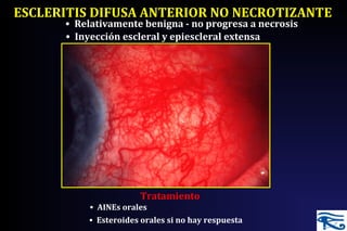 ESCLERITIS DIFUSA ANTERIOR NO NECROTIZANTE
• Inyección escleral y epiescleral extensa
• Relativamente benigna - no progresa a necrosis
• Esteroides orales si no hay respuesta
Tratamiento
• AINEs orales
 