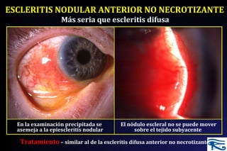 ESCLERITIS NODULAR ANTERIOR NO NECROTIZANTE
El nódulo escleral no se puede mover
sobre el tejido subyacente
Más seria que escleritis difusa
En la examinación precipitada se
asemeja a la epiescleritis nodular
Tratamiento – similar al de la escleritis difusa anterior no necrotizante
 