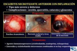 ESCLERITIS NECROTIZANTE ANTERIOR CON INFLAMACIÓN
Progresión
• Tipo más severo y doloroso
• Complicaciones - uveítis, queratitis, catarata y glaucoma
Tratamiento
• Oral steroids
• Agentes Immunosupresores (ciclofosfamida, azatioprina, ciclosporina)
• Esteroides y ciclofosfamida intravenosos combinados si no hay respuesta
Necrosis escleral y úvea
visible
Extensión y coalescencia
de la necrosis
Parches Avasculares
 