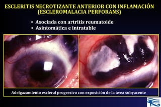 • Asintomática e intratable
• Asociada con artritis reumatoide
Adelgazamiento escleral progresivo con exposición de la úvea subyacente
ESCLERITIS NECROTIZANTE ANTERIOR CON INFLAMACIÓN
(ESCLEROMALACIA PERFORANS)
 