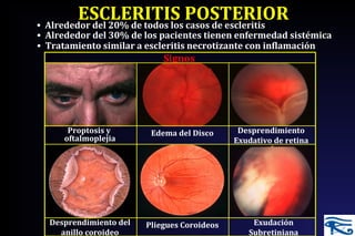 ESCLERITIS POSTERIOR
Signos
• Alrededor del 20% de todos los casos de escleritis
• Alrededor del 30% de los pacientes tienen enfermedad sistémica
• Tratamiento similar a escleritis necrotizante con inflamación
Pliegues Coroideos Exudación
Subretiniana
Proptosis y
oftalmoplejia
Edema del Disco Desprendimiento
Exudativo de retina
Desprendimiento del
anillo coroideo
 