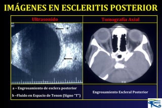 IMÁGENES EN ESCLERITIS POSTERIOR
Ultrasonido
a – Engrosamiento de esclera posterior
b –Fluido en Espacio de Tenon (Signo “T”)
Tomografía Axial
Engrosamiento Escleral Posterior
a
b
a
 