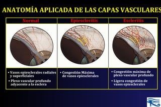ANATOMÍA APLICADA DE LAS CAPAS VASCULARES
Escleritis
• Congestión máxima de
plexo vascular profundo
• Ligera congestión de
vasos epiesclerales
• Congestión Máxima
de vasos epiesclerales
EpiescleritisNormal
• Vasos epiesclerales radiales
y superficiales
• Plexo vascular profundo
adyacente a la esclera
 
