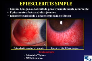 EPIESCLERITIS SIMPLE
• Común, benigna, autolimitada pero frecuentemente recurrente
• Típicamente afecta a adultos jóvenes
Tratamiento
• Raramente asociada a una enfermedad sistémica
Epiescleritis sectorial simple Epiescleritis difusa simple
• Esteroides Tópicos
• AINEs Sistémico
 