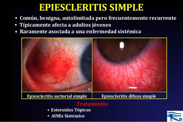Resultado de imagen para epiescleritis