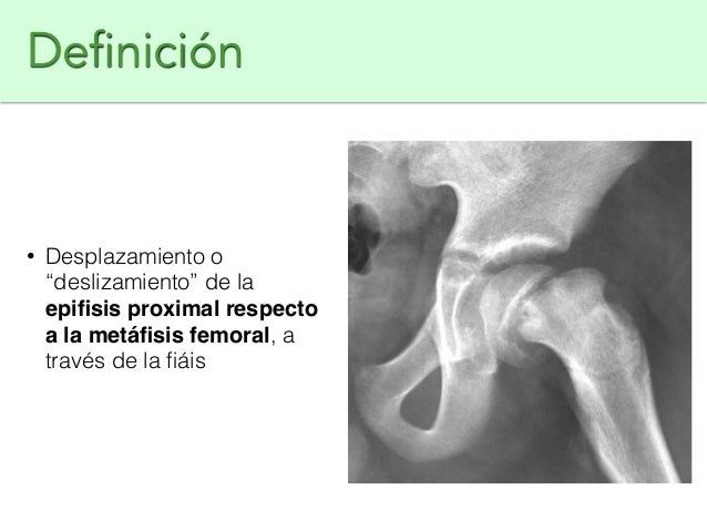 Epifisiolisis