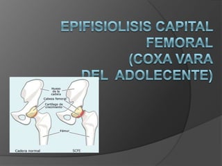 EPIFISIOLISIS CAPITAL FEMORAL(coxa varadel  adolecente) 