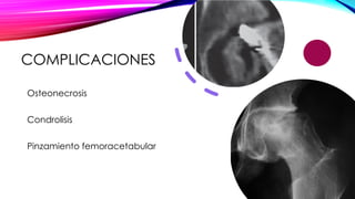 Epifisiolistesis. Diagnostico y tratamiento | PPTX
