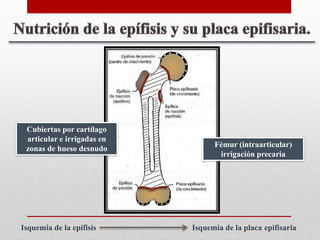 Epifisitis | PPT