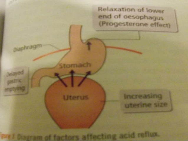 Epigastric Pain In Pregnancy epigastric-pain-in-pregnancy