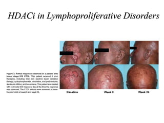 HDACi in Lymphoproliferative Disorders
 