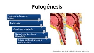 Patogénesis
Patógenos colonizan la
faringe
Bacteremia
Infección de la epiglotis
Rápido inicio de edema
inflamatorio
Reduce significativamente la
apertura aérea
John Udeani, MD. (2016). Pediatric Epiglottitis. Medscape.
 