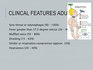 CLINCAL FEATURES ADULTS
Sore throat or odynophagia (90 – 100%)
Fever greater than 37.5 degree celcius (26 – 90%)
Muffled voice (50 – 80%)
Drooling (15 – 65%)
Stridor or respiratory compromise (approx. 33%)
Hoarseness (20 – 40%)
 