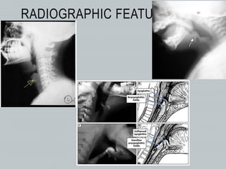 RADIOGRAPHIC FEATURES
 