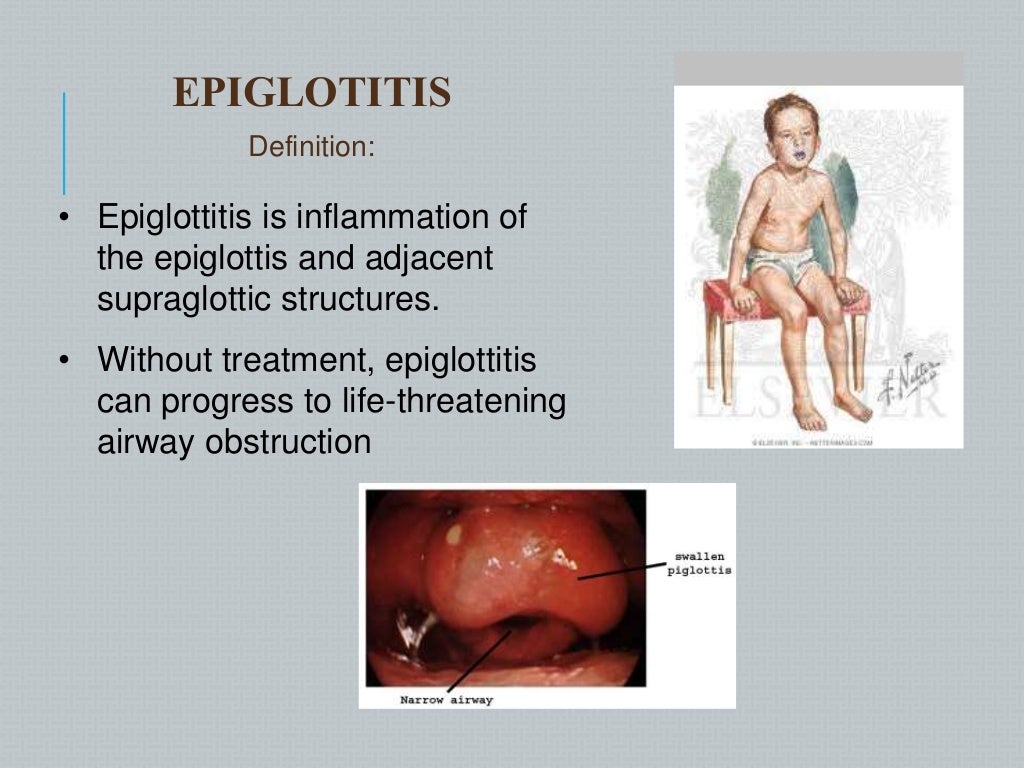 Epiglottitis