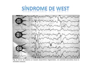CPHAP 022 Crisis Febriles & Status Epileptico