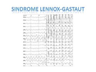 CPHAP 022 Crisis Febriles & Status Epileptico