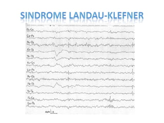 CPHAP 022 Crisis Febriles & Status Epileptico