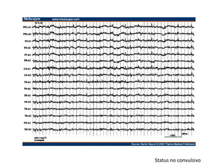 CPHAP 022 Crisis Febriles & Status Epileptico