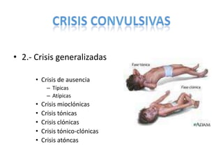 CPHAP 022 Crisis Febriles & Status Epileptico