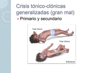 Crisis tónico-clónicas
generalizadas (gran mal)
 Primario y secundario
 