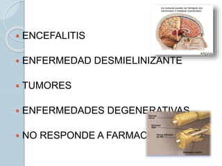  ENCEFALITIS
 ENFERMEDAD DESMIELINIZANTE
 TUMORES
 ENFERMEDADES DEGENERATIVAS
 NO RESPONDE A FARMACOS
 