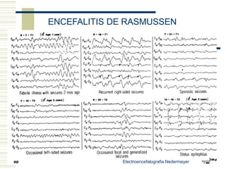 ElectroencefalogramaNombre del paciente y edadEstado en el que se realizóRitmo de fondoSimetríaSincroníaGradienteCambios con maniobras de provocaciónPresencia de grafoelementos paroxísticos