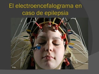 El electroencefalograma en caso de epilepsia 
