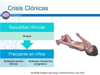 Crisis Clónicas
Frecuente en niños
Epilepsia severa
clónica
Epilepsia mioclonica
progresiva
Sacudidas rítmicas
Grupos
Daroff RB. Bradley’s Neurology in Clinical Practice. 6 ed. 2012
 
